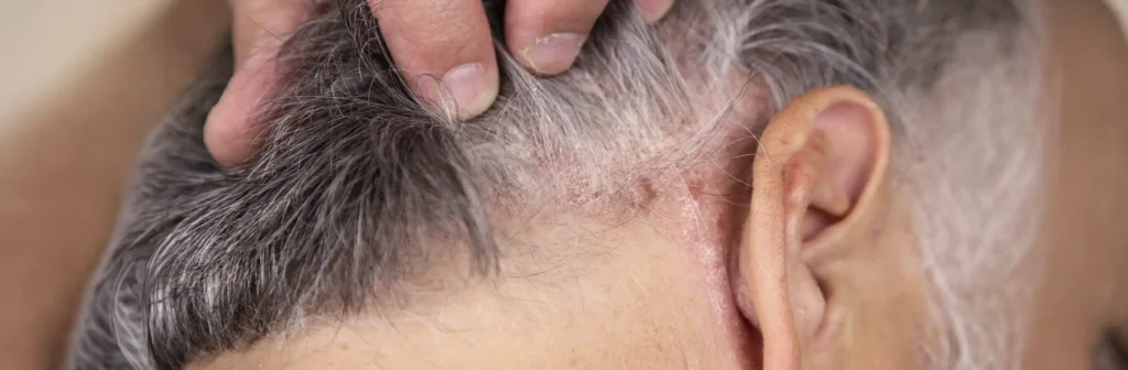 Scalp Psoriasis